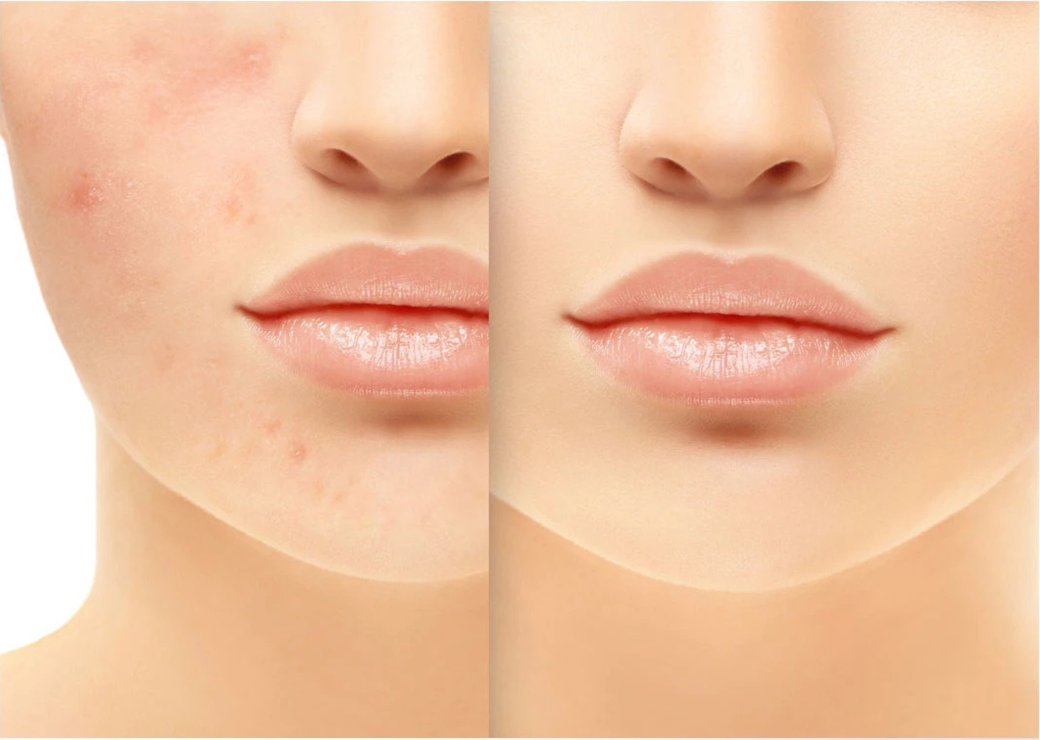 Behandlung von Aknenarben: Medizinisches Silikon | Biodermis-Shop.com - Biodermis-Shop