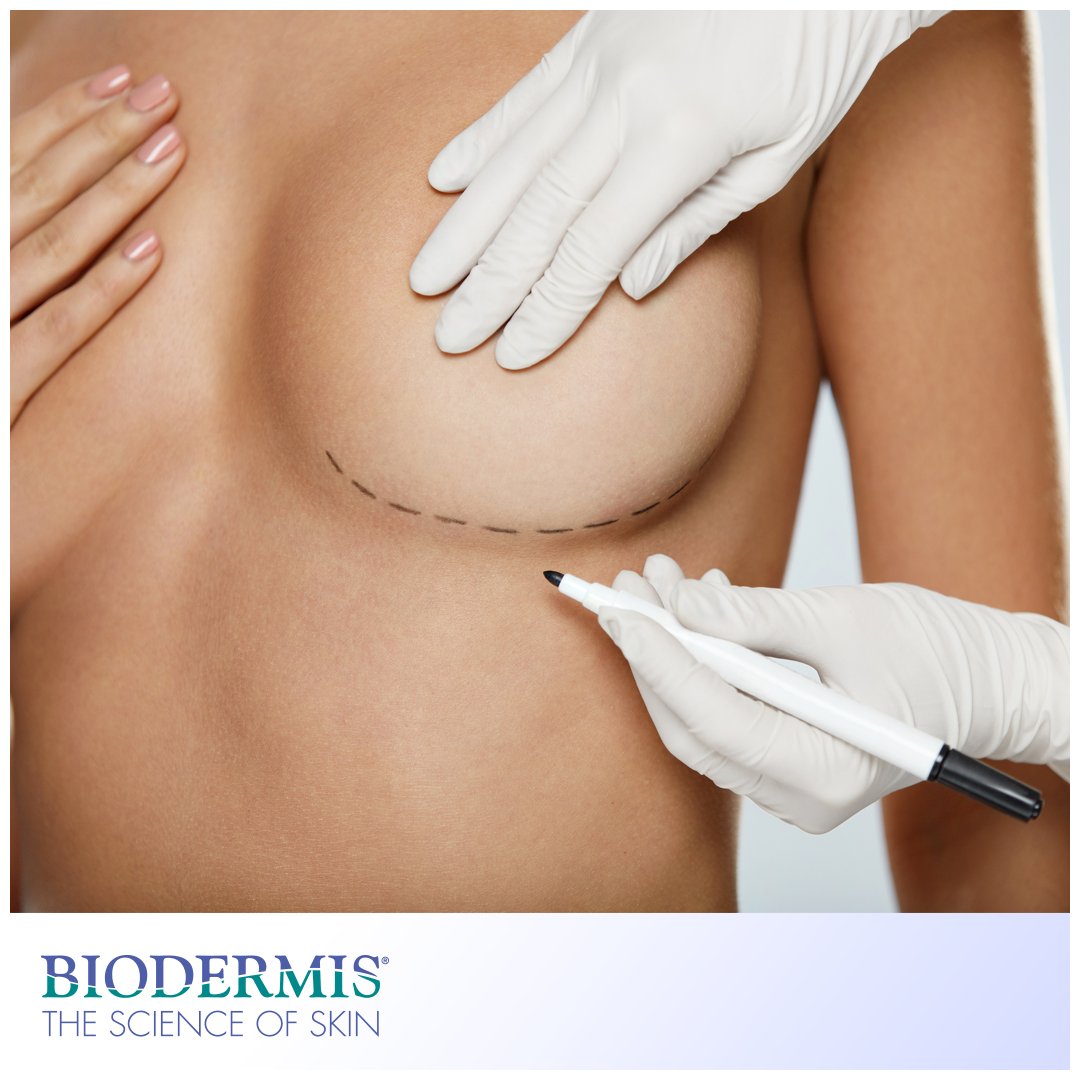 Narben nach Brustvergrößerung | biodermis-shop.com - Biodermis-Shop