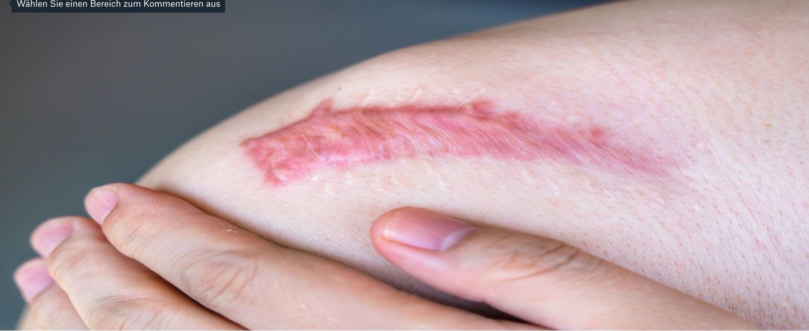 Wie lange dauert es bis eine Narbe verblasst? | biodermis-shop.com - Biodermis-Shop