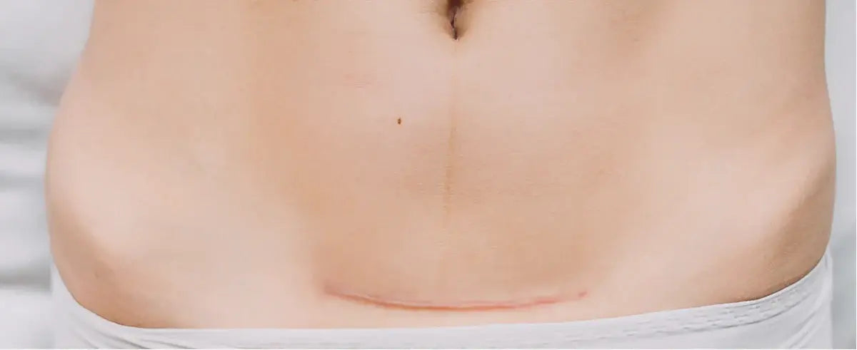 Kaiserschnitt-Narben effektiv behandeln | biodermis-shop.com