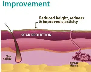 Improvement