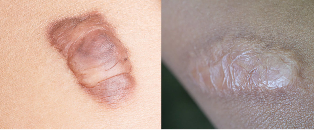 Keloiden und hypertrophen Narben vorbeugen | biodermis-shop.com - Biodermis-Shop